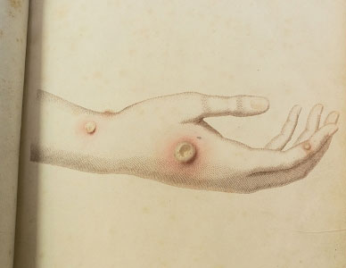 Hand with boils and infections